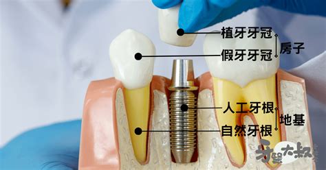 缺牙會漏財嗎|缺門牙漏財怎麼辦？缺門牙可以植牙嗎？